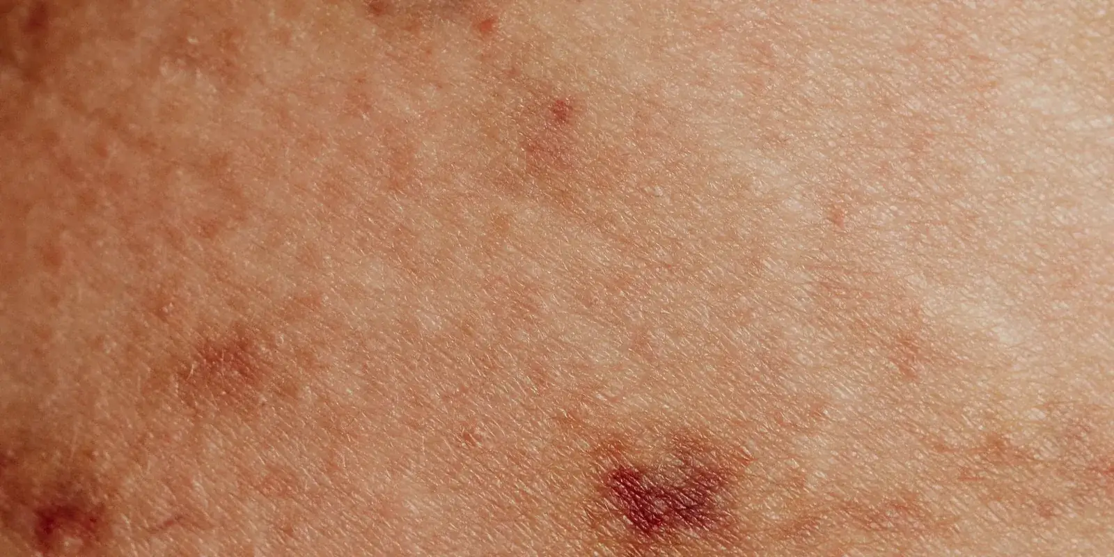 Marcas rojizas sobre la piel de la pierna